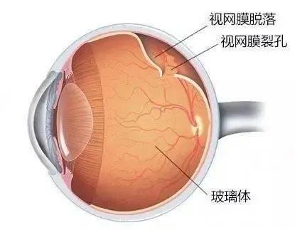 体验跳水视网膜脱离